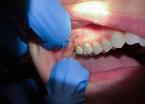 Best Emergency Denture Repair in Swanton, OH