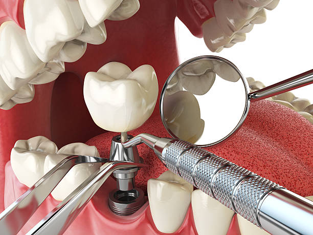 Best Emergency Denture Repair in Swanton, OH